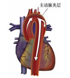 世界顶级心血管期刊：“旋风杀手”的防治新靶点，被中国团队找到了